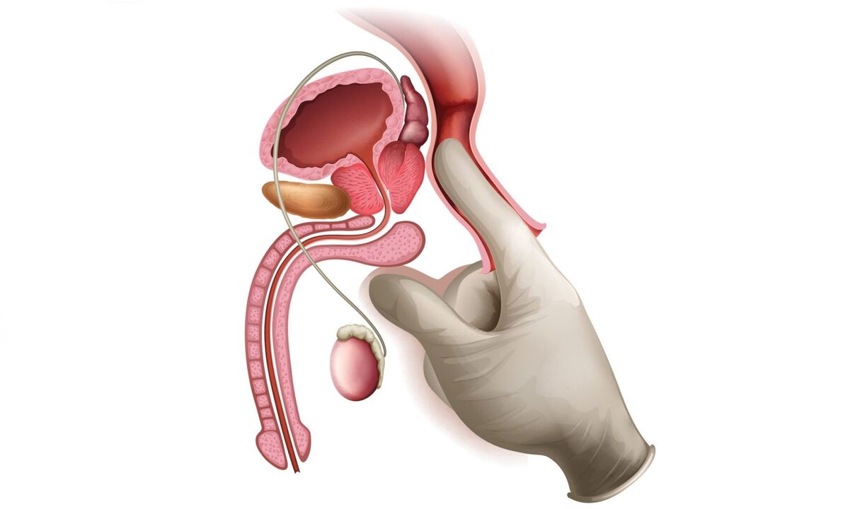 prostatos masažas sergant prostatitu